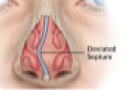 Endoscopic Sinus Surgery